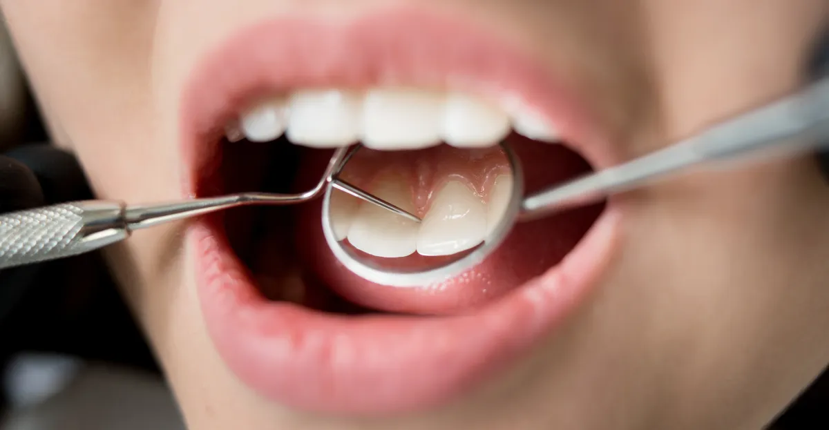Everything You Need to Know About Dental Fillings