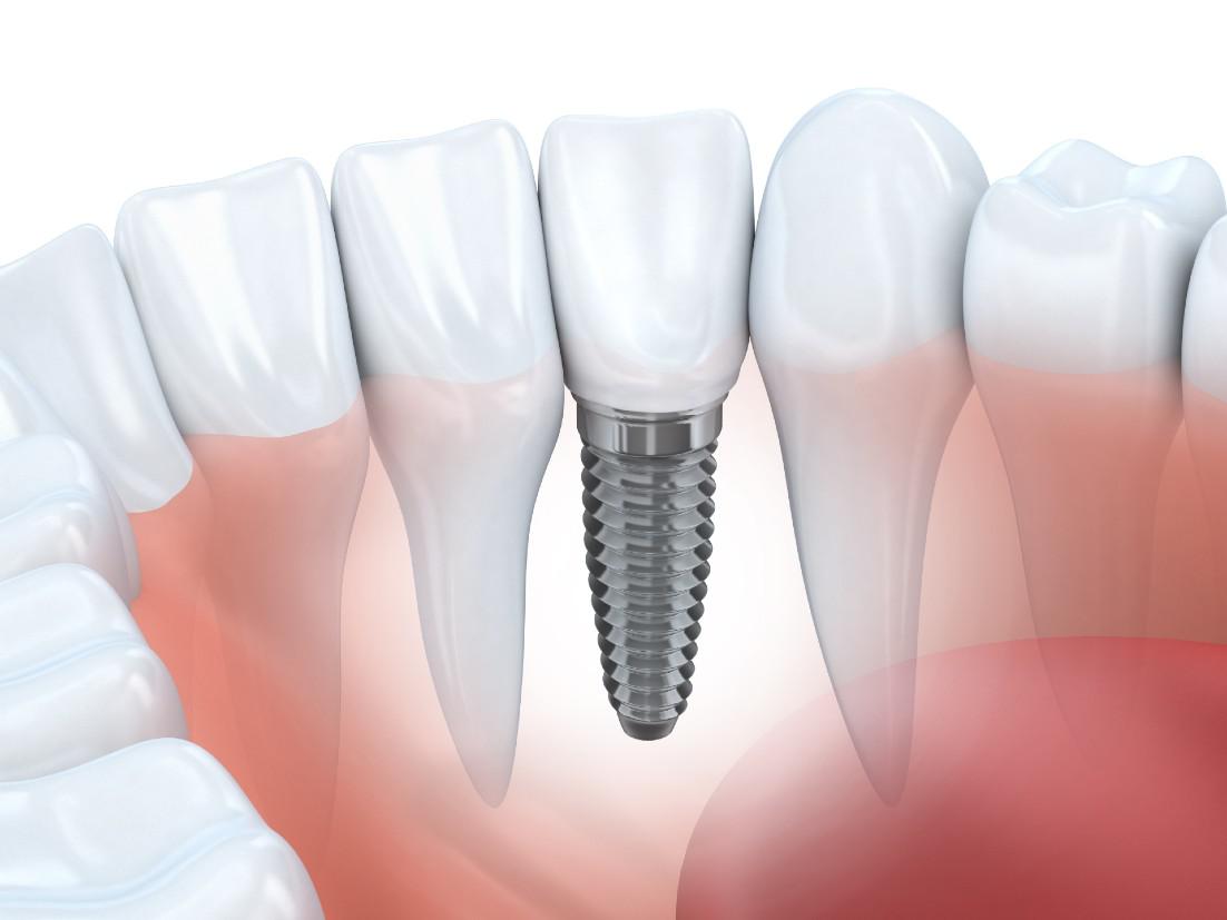 Dental Implants Sunnyvale, CA