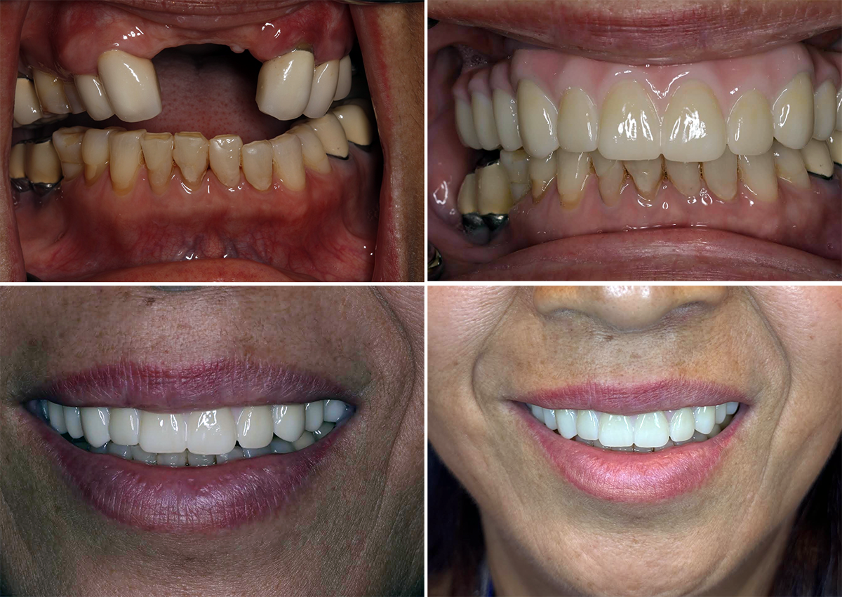 implant supported dentures enhanced patients smile