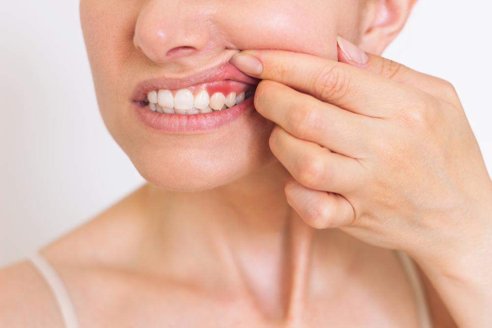 Painful Pockets: Treating the Periodontal Abscess