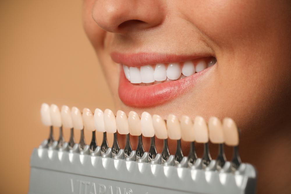 FAQ About Veneers