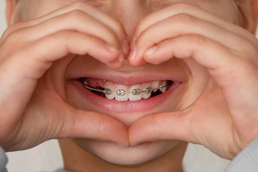 How Braces Improve Your Oral Health