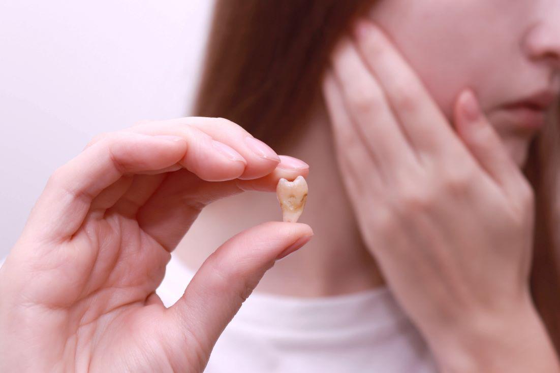 Wisdom Teeth Recovery